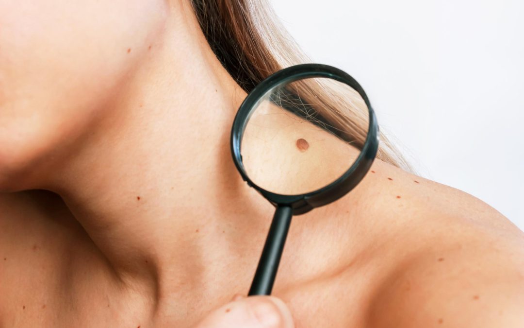 Skin Tags, Cysts, and Moles: Why Quick Removal Can Save You Trouble Later